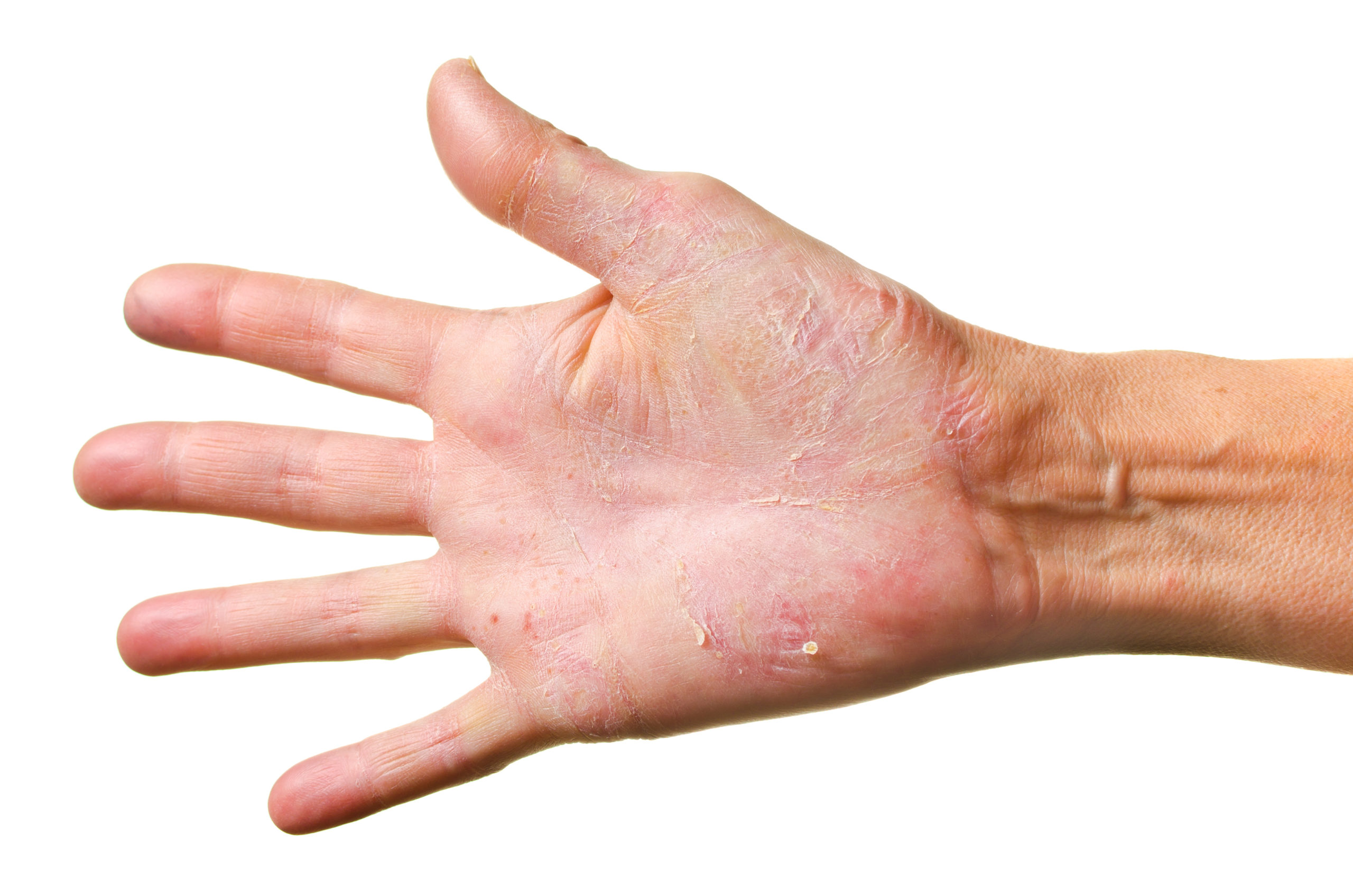 Eczema / Atopic Dermatitis - West Dermatology