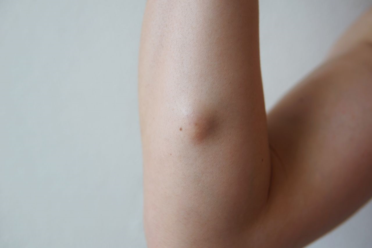 Cysts - West Dermatology