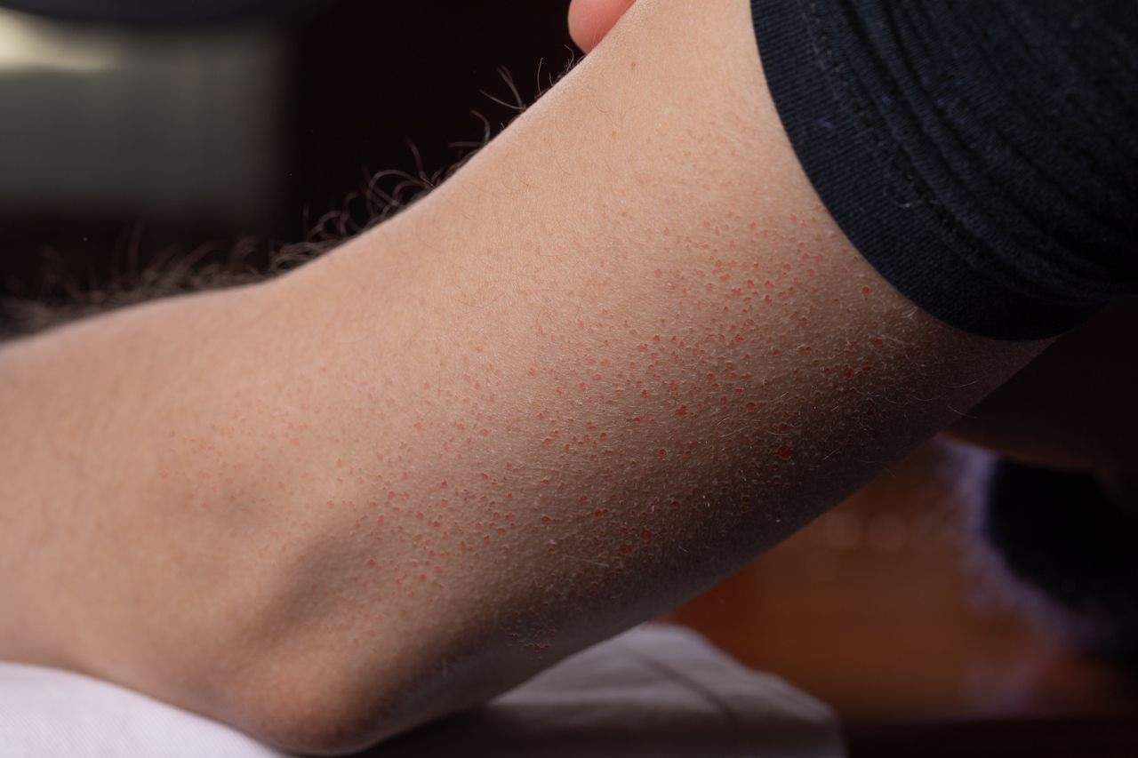 ghk cu keratosis pilaris Keratosis Pilaris