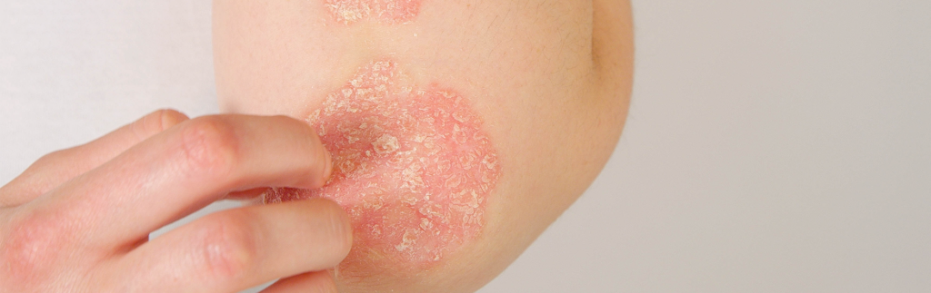 A patch of psoriasis on someone's elbow